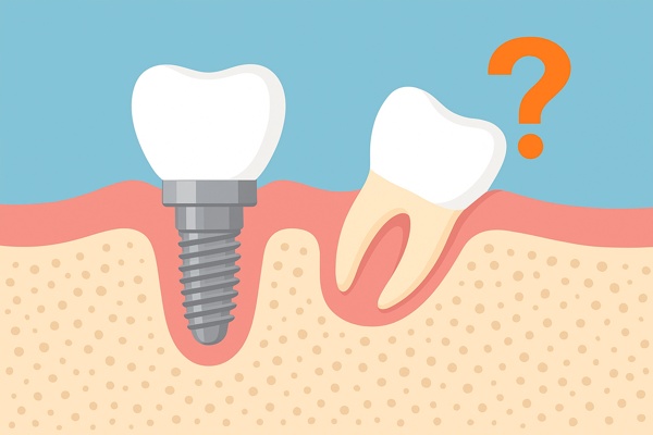 Имплантат зуба: прочный фундамент или риск выпадения?