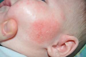 Аллергия на мяту у взрослых и маленьких детей