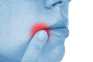 Заеды в уголках рта: причины и распознавание