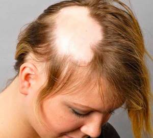 Выпадение волос у женщин - 7 основных причин