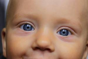 Мешки под глазами: причина появления у взрослых и детей