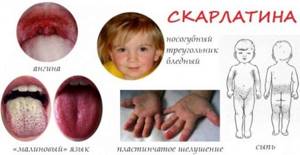 Скарлатина: симптомы и этапы развития
