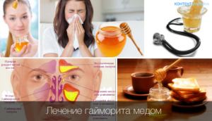 Лечение гайморита медом: популярные рецепты