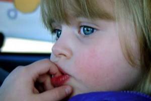 Заеды в уголках рта: причины и распознавание