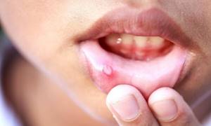 Простуда в носу: чем лечить герпес?
