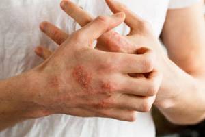 Аллергия на мяту у взрослых и маленьких детей