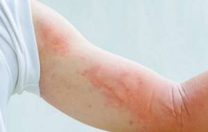 Аллергия на имбирь: симптоматика и методы лечения