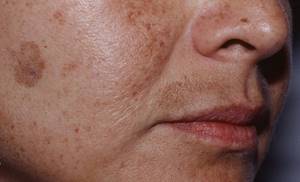 Пигментные пятна на лице: основные типы и причины появления