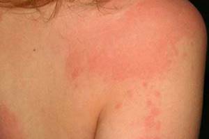 Аллергия на имбирь: симптоматика и методы лечения
