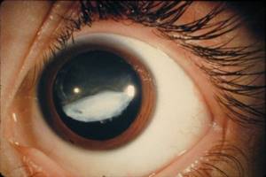 Глазное давление - симптомы повышенного и пониженного