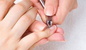Заусеницы на пальцах – причины возникновения и методы лечения