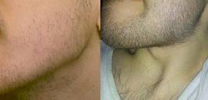 Касторовое масло для бороды: на самом ли деле помогает для роста, как использовать и правила применения